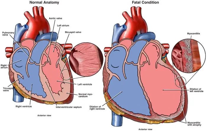 Myocarditis-Vector-Image.jpg